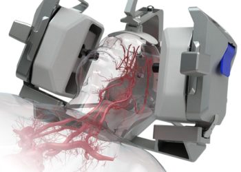 NovaSignal’s AI-Guided Robotic Platform Aims To Change The Diagnosis Of Stroke