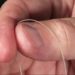 SPR Therapeutics runs up $37M VC funding for Sprint pain relief device
