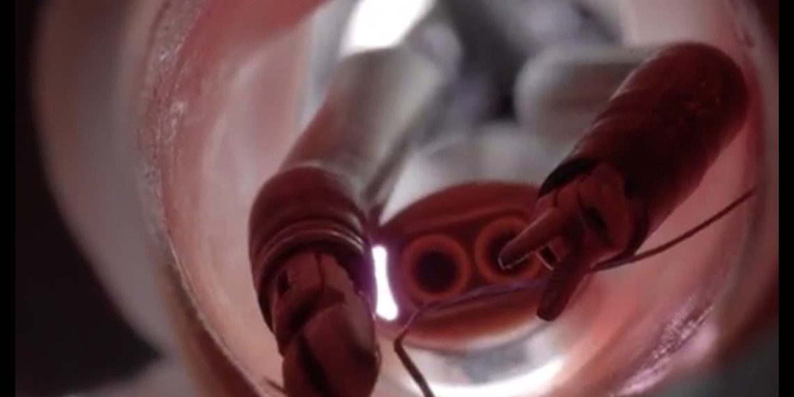 YOUR HEALTH: Using robots to treat the toughest of cancers