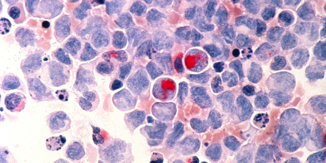 Foresite and GV pour $40M into startup’s move to CHIP into new disease biology