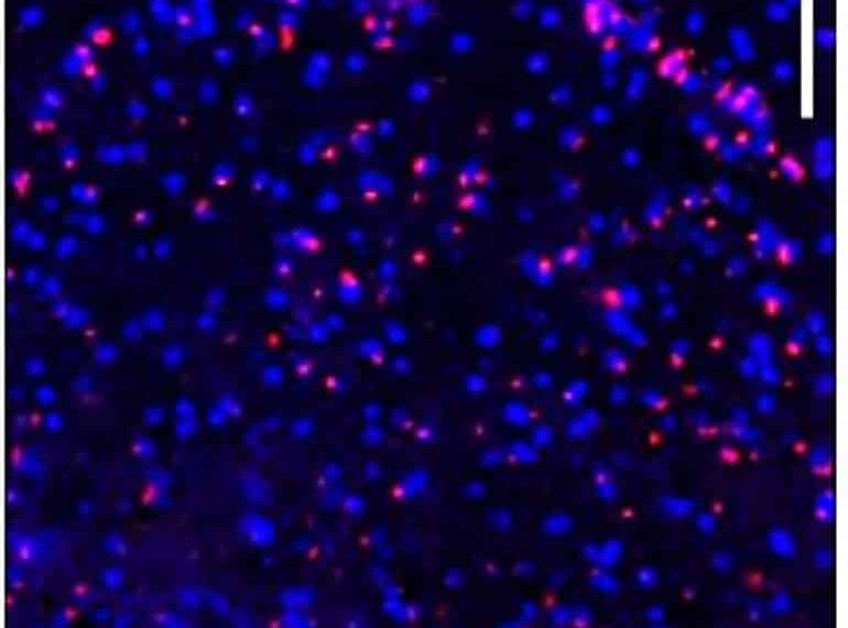 Iron Accumulation Linked With Age-Related Cognitive Decline