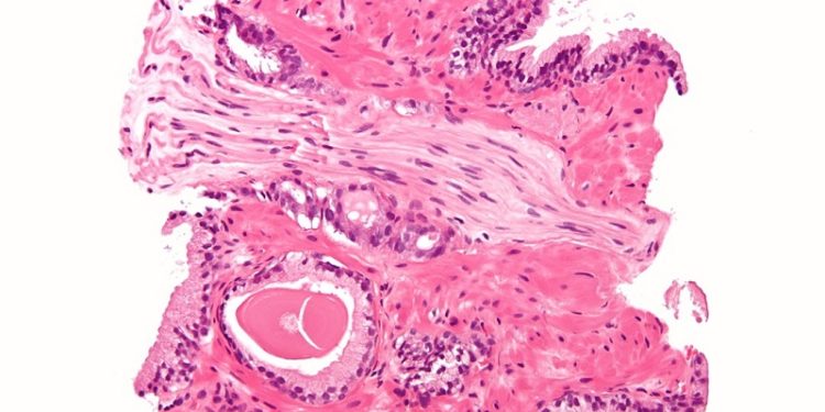 Biobot and BEBIG to partner on robotic-guided solution for prostate cancer