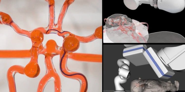 Telerobotic System Helps Surgeons Remotely Treat Strokes