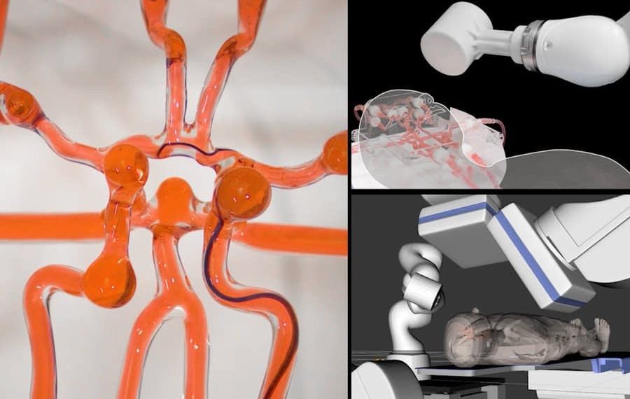 Telerobotic System Helps Surgeons Remotely Treat Strokes