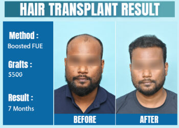 Hair Transplant In Delhi: Before, During, and After Procedures
