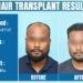 Hair Transplant In Delhi: Before, During, and After Procedures